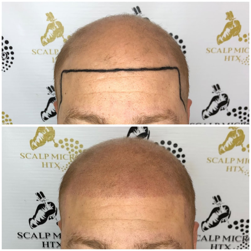 scalp-micro-houston