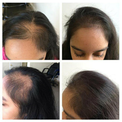 womens-thinning-hairloss-solution-houston-orig_orig